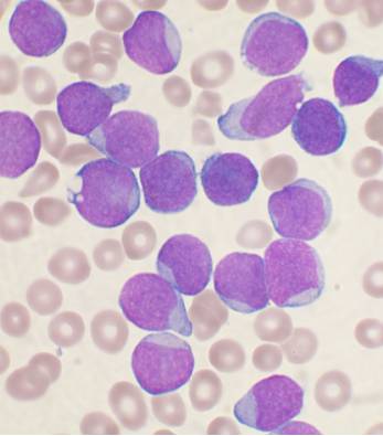 Imagem de Leucemia Linfocítica Crônica