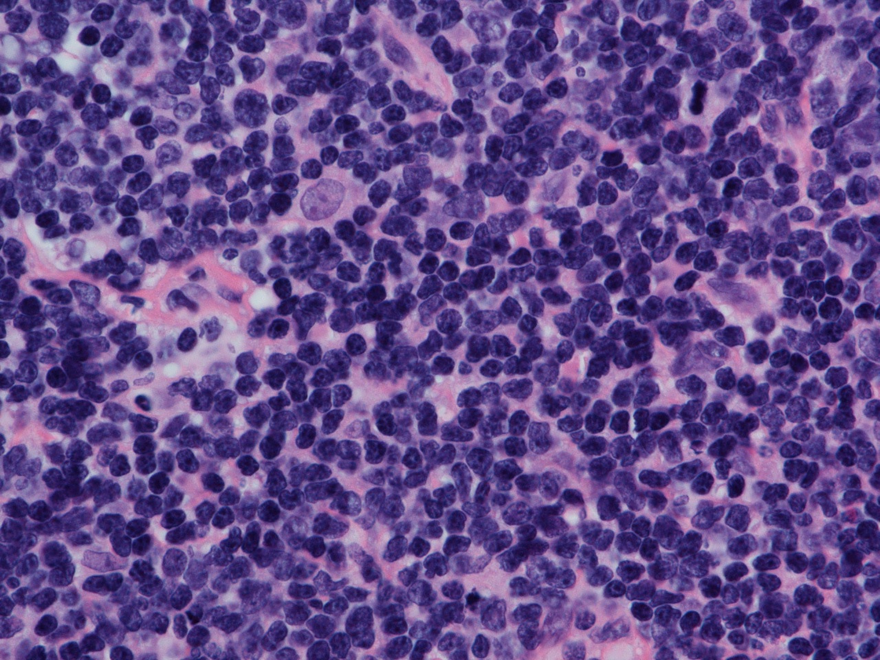 Amostra de sangue, Linfoma de Hodgkin