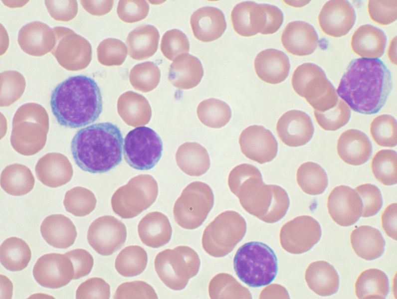 Imagem de Leucemia Linfocítica Crônica